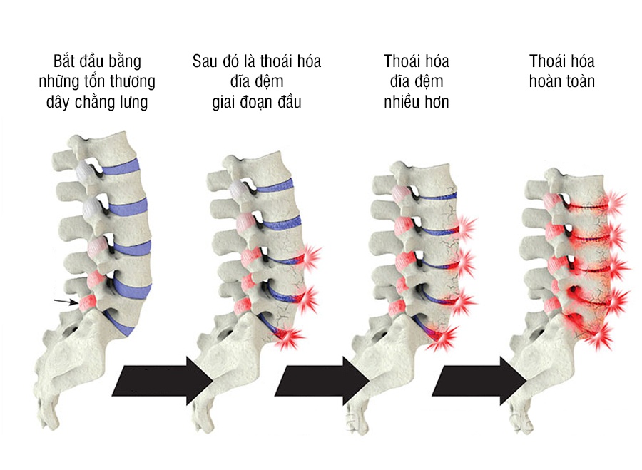 4 giai đoạn của thoái hóa cột sống