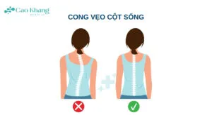 Cong vẹo cột sống