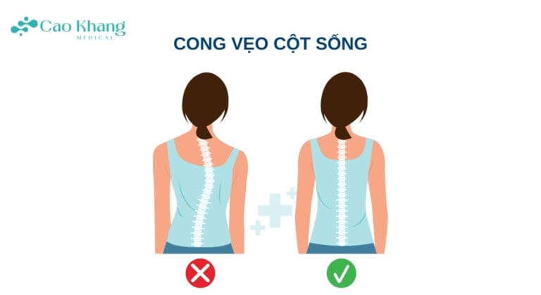 Cong vẹo cột sống