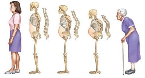 dấu hiệu bệnh loãng xương
