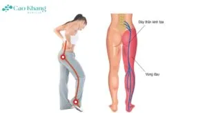 đau thần kinh tọa