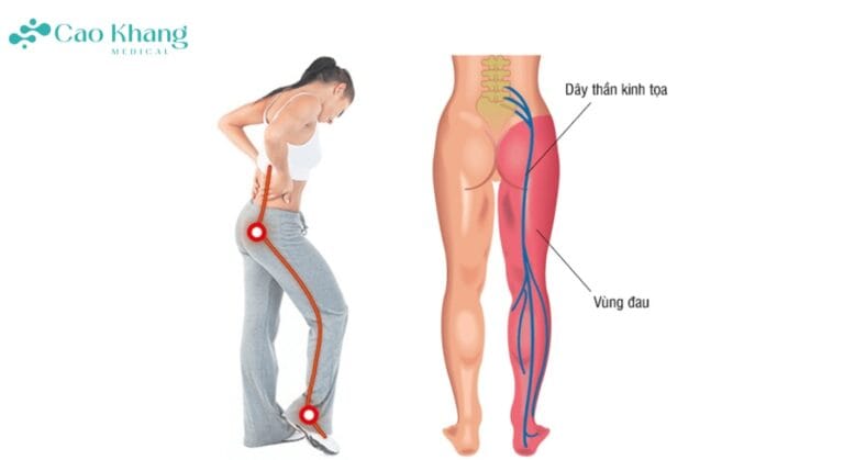 đau thần kinh tọa