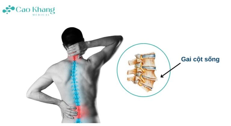 Gai cột sống