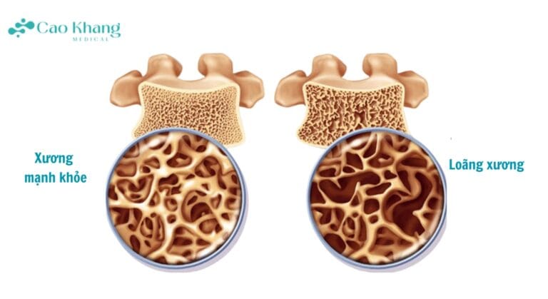 Bệnh loãng xương