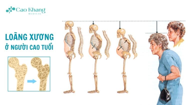 loãng xương ở người cao tuổi