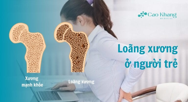 loãng xương ở người trẻ