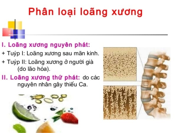 Phân loại bệnh loãng xương