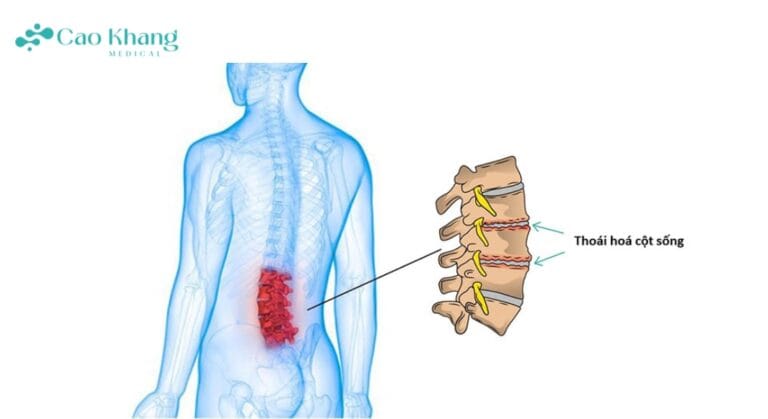 thoái hóa cột sống
