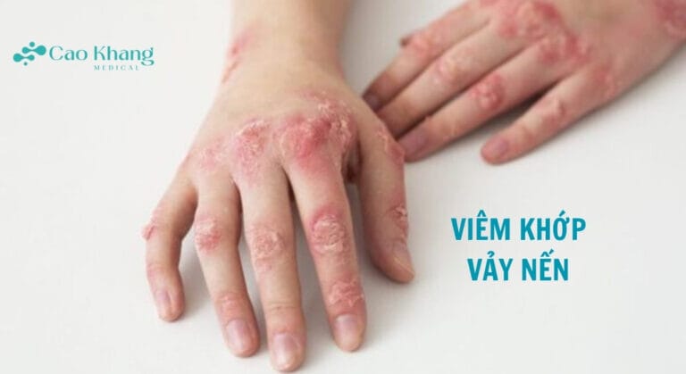 VIÊM KHỚP VẢY NẾN