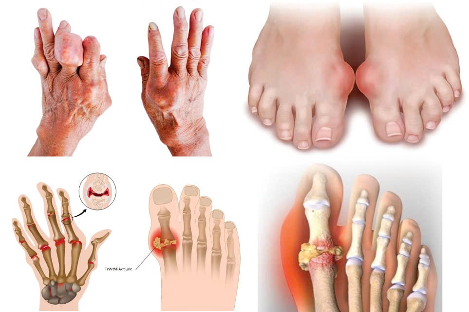 bệnh gút vô căn là gì?