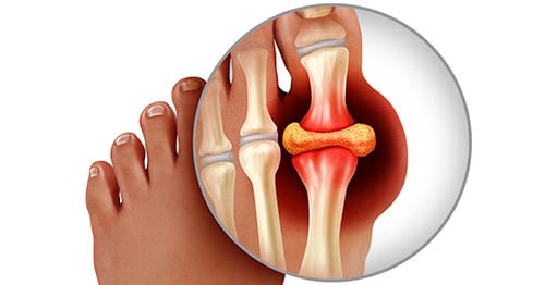 bênh gout