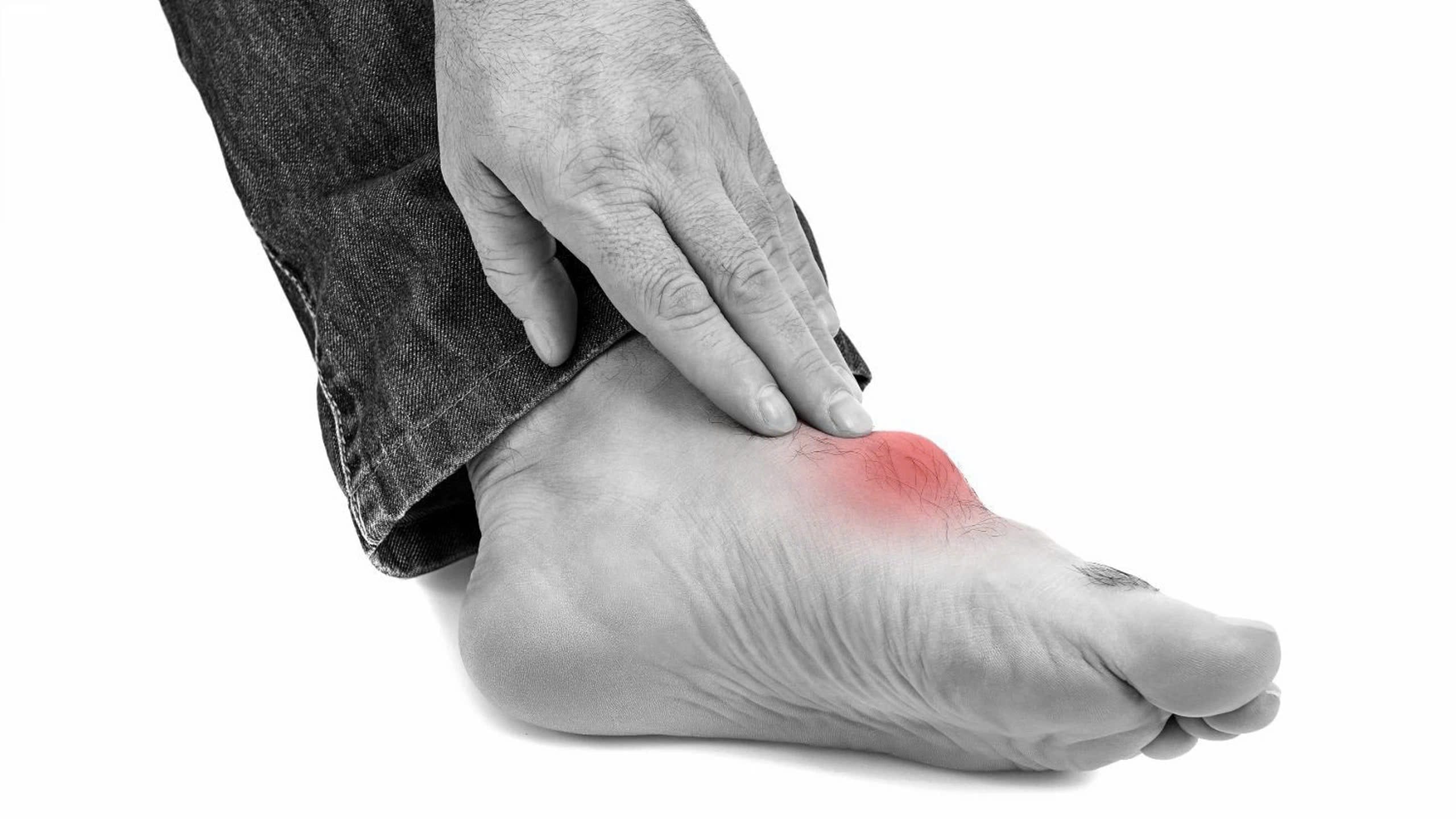 bệnh gút cấp tính