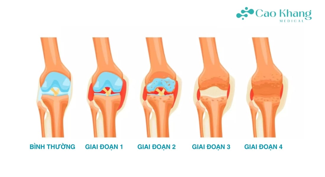các giai đoạnviêm khớp dạng thấp