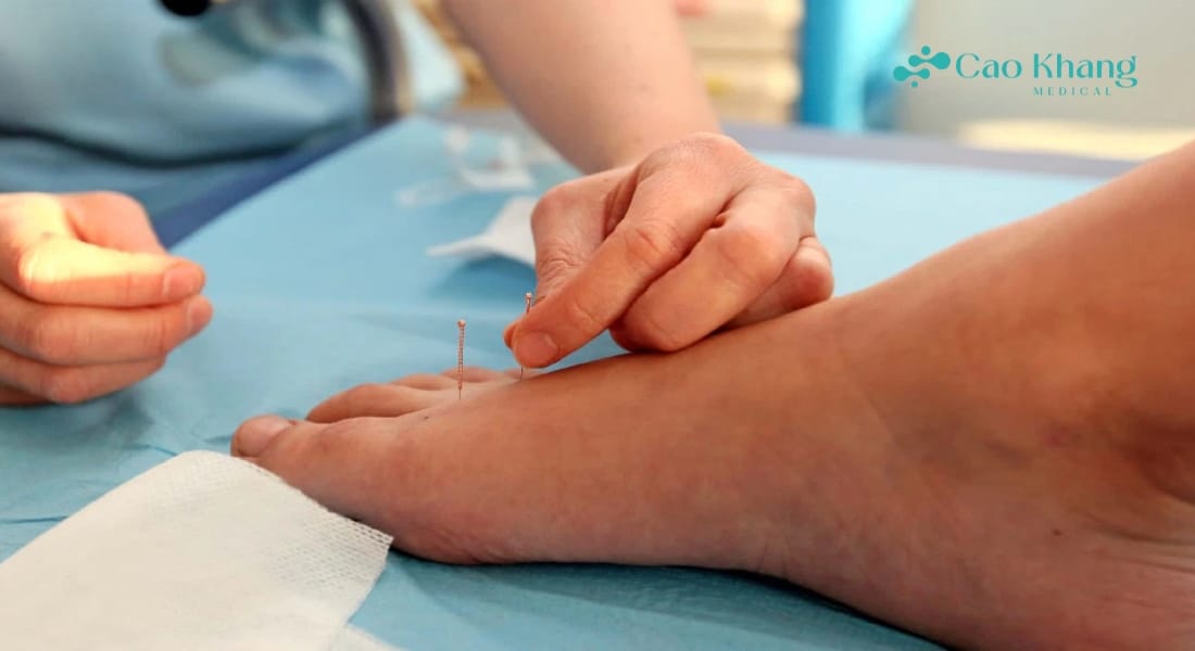 chân cứu viêm khớp bàn chân