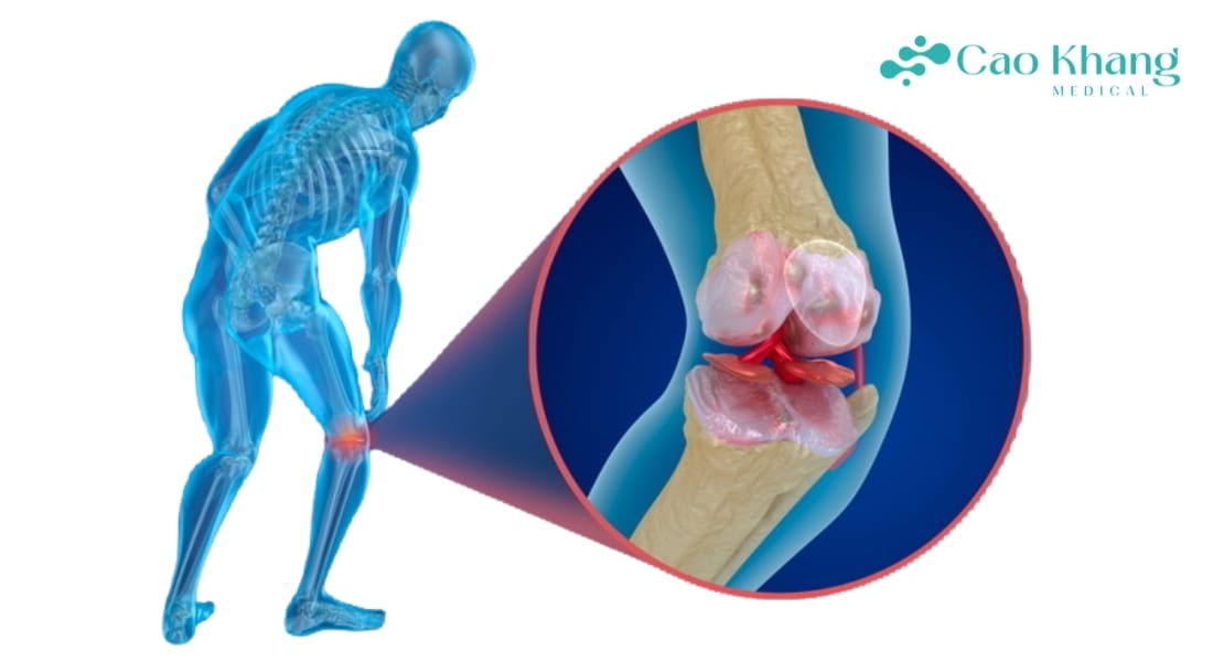 dấu hiệu viêm khớp gối