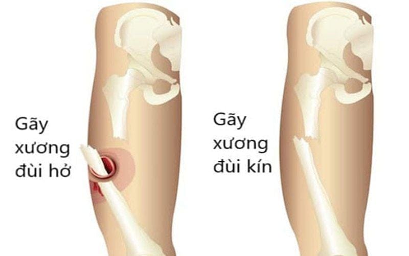 gãy xương kín và hở
