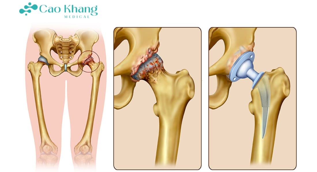 thay khớp háng