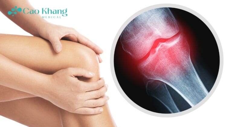 thoái hóa khớp