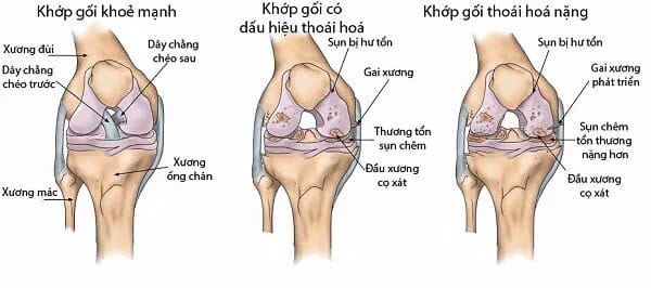 thoái hóa khớp gối
