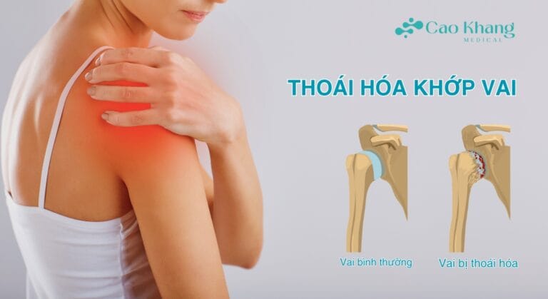 thoái hóa khớp vai