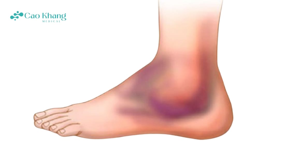 triệu chứng viêm khớp mắt cá chân