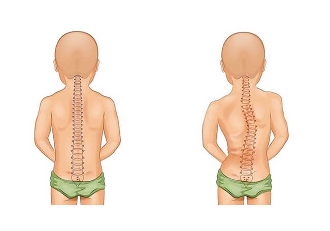 cong vẹo cột sống