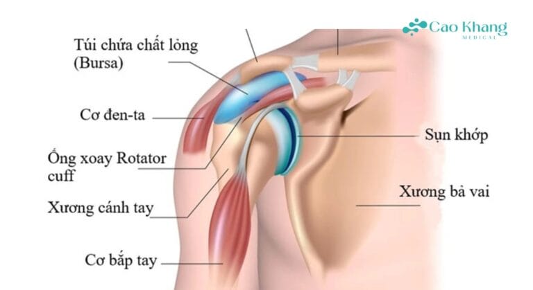 viêm bao hoạt dịch khớp vai