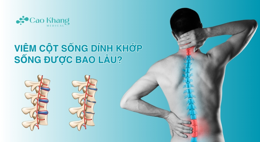 viêm cột sống dính khớp sống được bao lâu