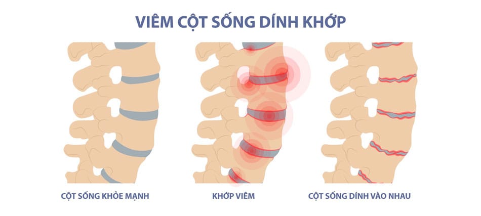 viem cot song dinh khop