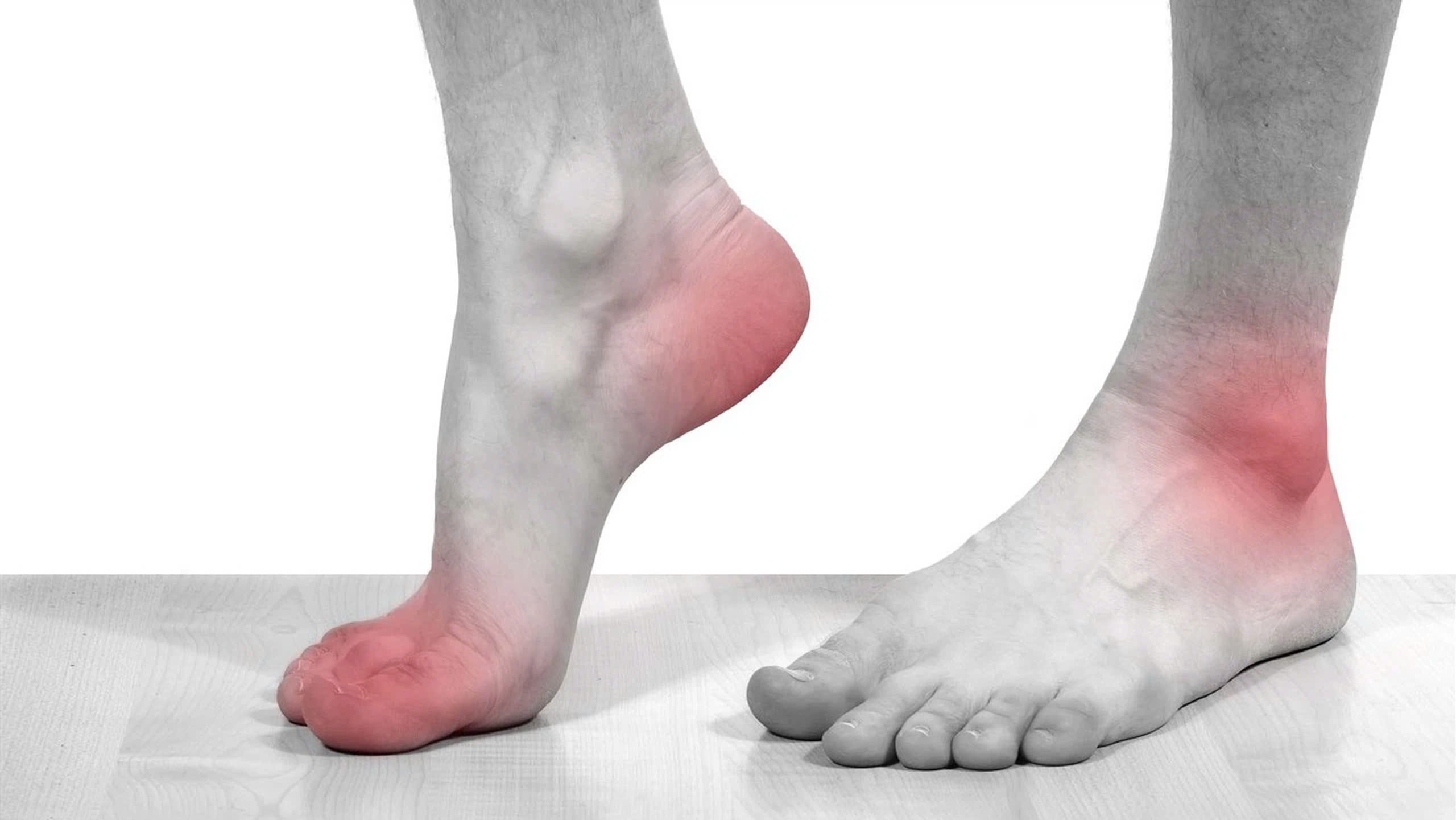 viêm khớp bàn chân