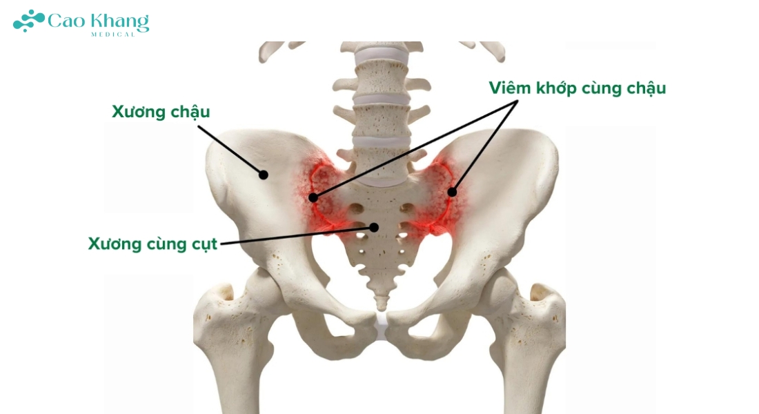 viêm khớp cùng chậu