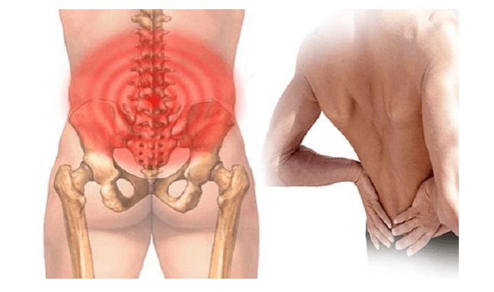 viêm khớp cùng chậu