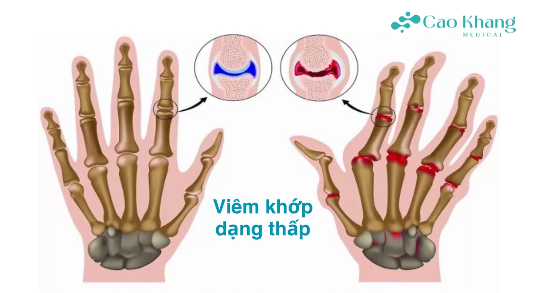 viêm khớp dạng thấp