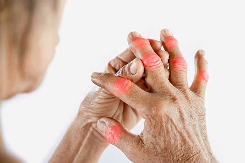 viêm khớp dạng thấp 3