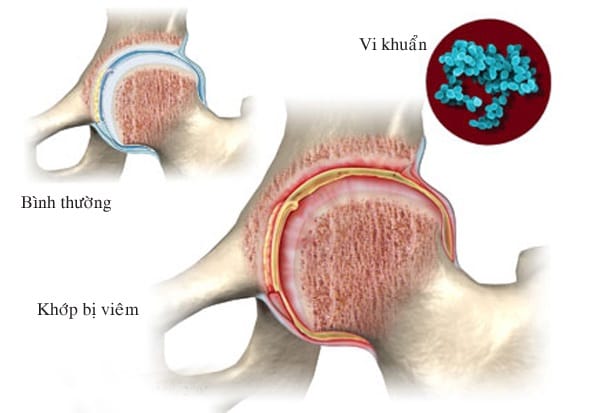 viêm khớp nhiễm khuẩn 1