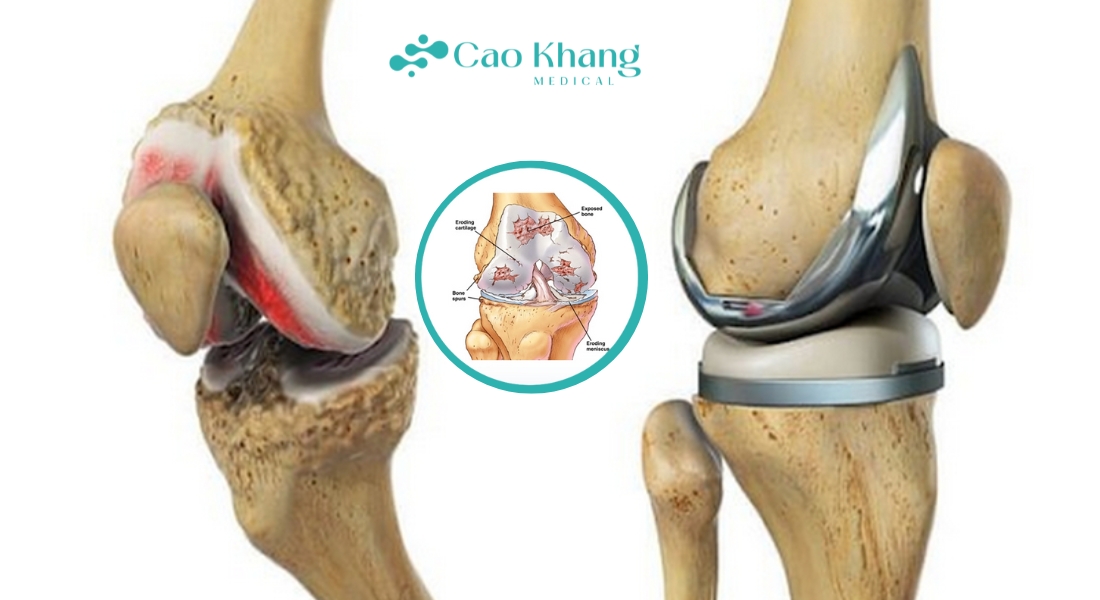 viêm khớp nhiễm khuẩn
