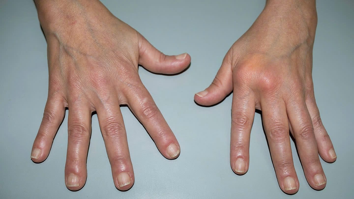 vêm khớp tự miễn