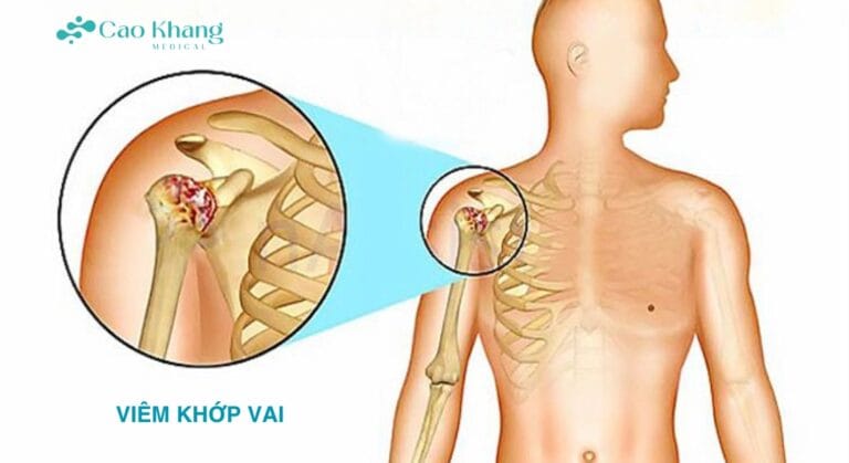 viêm khớp vai