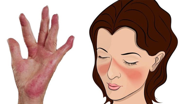 Bệnh-lupus-ban-đỏ-là-gì