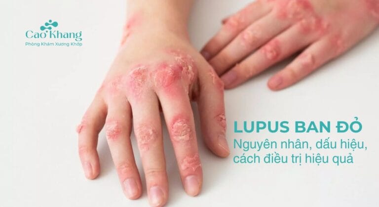 Lupus ban đỏ