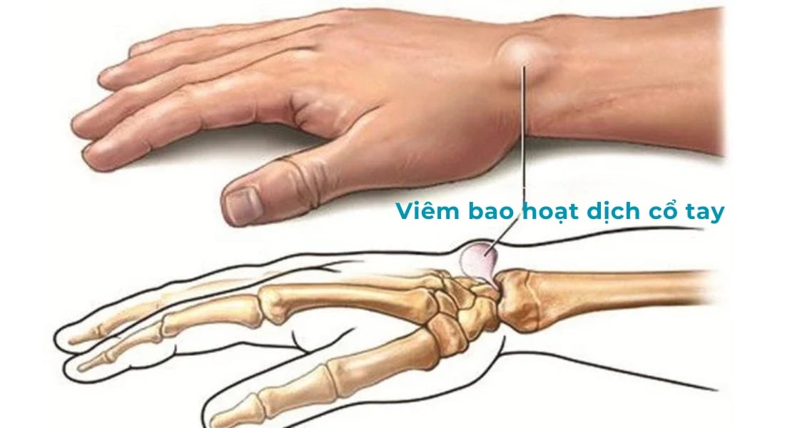 VIÊM BAO HOẠT DỊCH CỔ TAY (1)