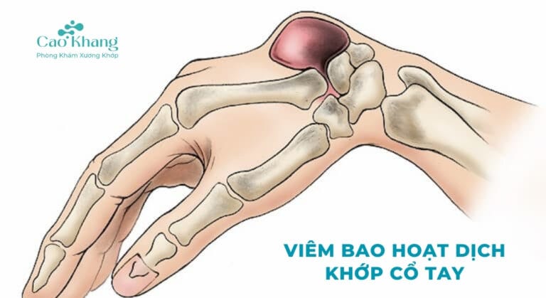 VIÊM BAO HOẠT DỊCH CỔ TAY