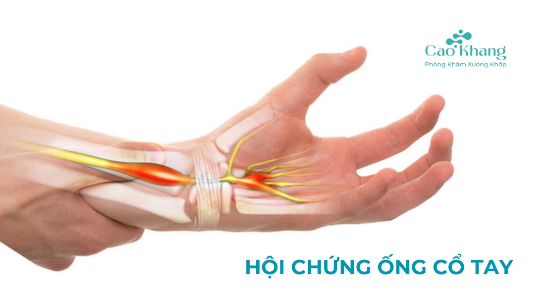 bệnh hội chứng ống cổ tay