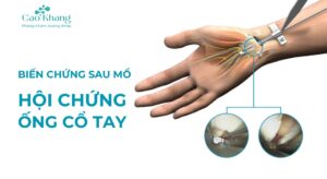 biến chứng sau mổ hội chứng ống cổ tay