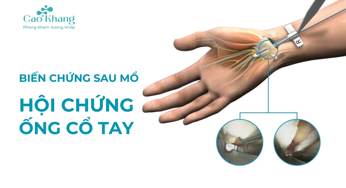 biến chứng sau mổ hội chứng ống cổ tay