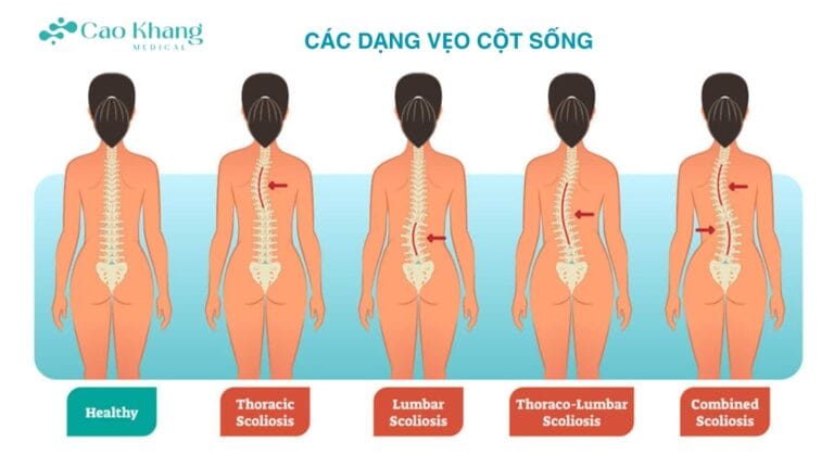 các dạng vẹo cột sống