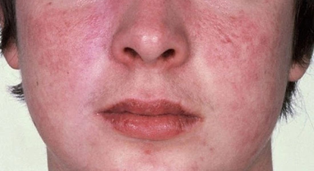 dấu hiệu lupus ban đỏ