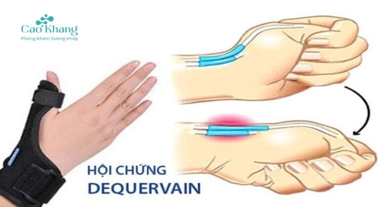 hội chứng de quervain