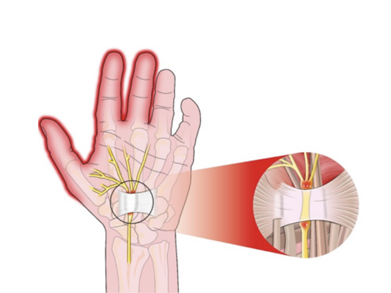 điều trị hội chứng ống cổ tay