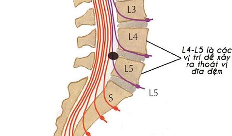 thoát vị đĩa đệm l4 l5